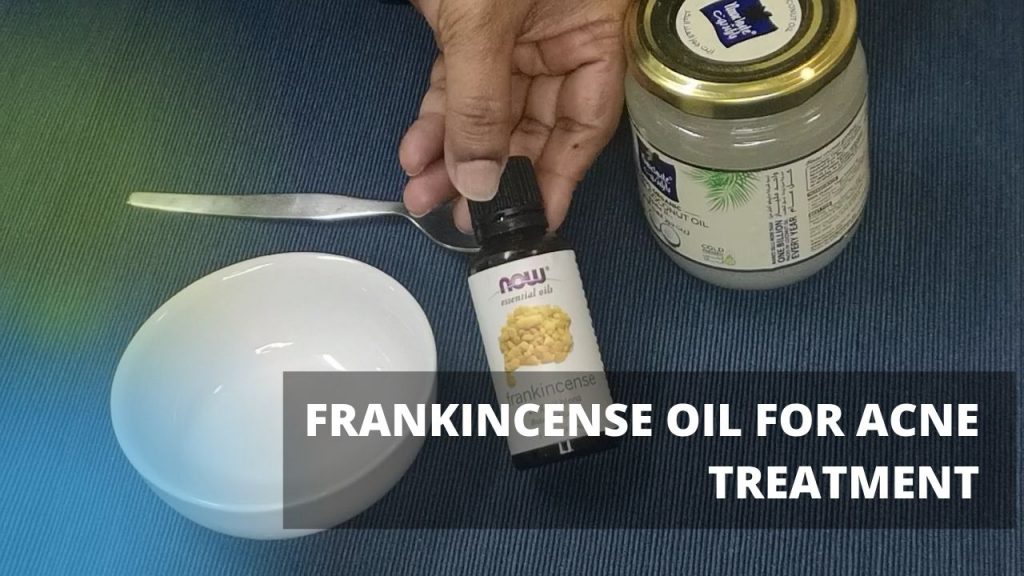 Frankincense Oil Face Mask Acne Homemade Treatment