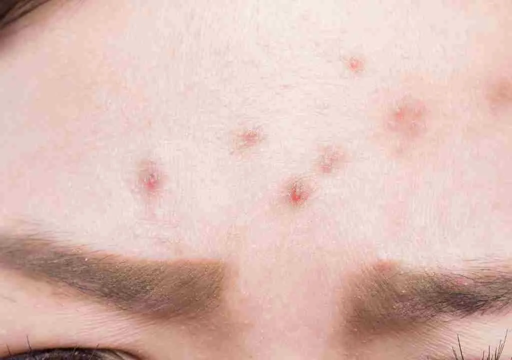 home remedies for tiny bumps on forehead